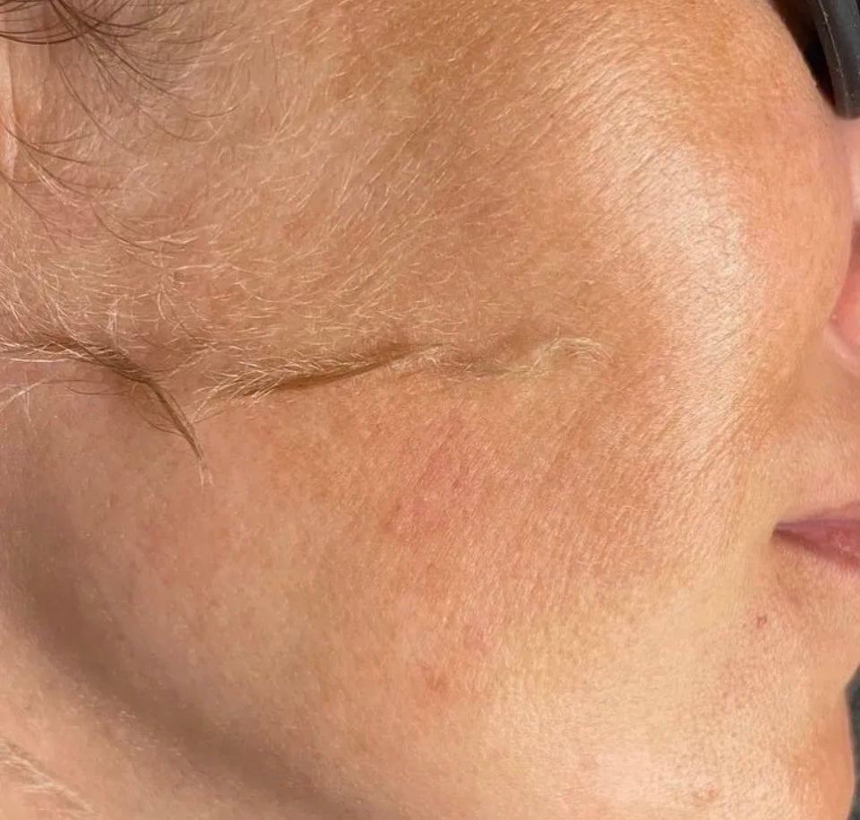 Dermaplaning